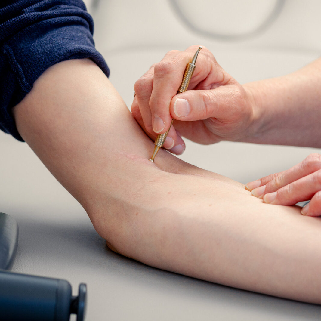 Während der Narbenbehandlung wird die Haut um die Narben leicht massiert | Physiotherapie Schmeddes